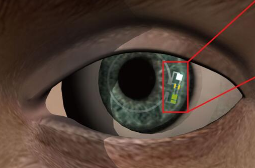 谷歌之后，又來一款血糖傳感智能隱形眼鏡